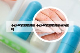 小孩寻常型银屑病 小孩寻常型银屑病会传染吗