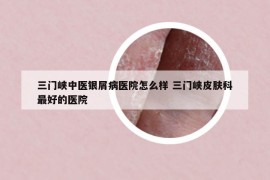 三门峡中医银屑病医院怎么样 三门峡皮肤科最好的医院