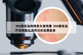 308激光治白斑多久有效果 308激光治疗白斑照几次可以长出黑色素