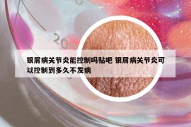 银屑病关节炎能控制吗贴吧 银屑病关节炎可以控制到多久不发病