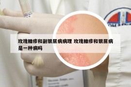 玫瑰糠疹和副银屑病病理 玫瑰糠疹和银屑病是一种病吗