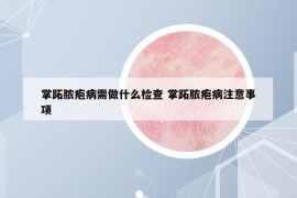 掌跖脓疱病需做什么检查 掌跖脓疱病注意事项