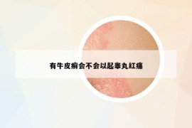 有牛皮癣会不会以起睾丸红痛