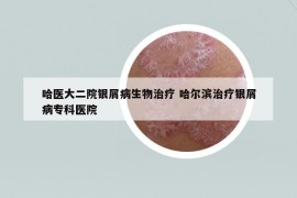 哈医大二院银屑病生物治疗 哈尔滨治疗银屑病专科医院