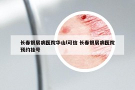 长春银屑病医院华山l可信 长春银屑病医院预约挂号