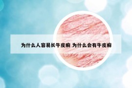 为什么人容易长牛皮癣 为什么会有牛皮癣
