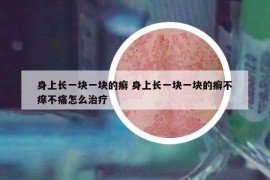 身上长一块一块的癣 身上长一块一块的癣不痒不痛怎么治疗