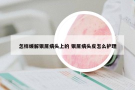怎样缓解银屑病头上的 银屑病头皮怎么护理