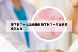 腋下长了一片红癣很痒 腋下长了一片红癣很痒怎么办
