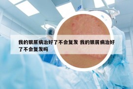 我的银屑病治好了不会复发 我的银屑病治好了不会复发吗