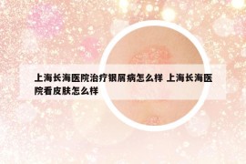 上海长海医院治疗银屑病怎么样 上海长海医院看皮肤怎么样