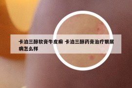卡泊三醇软膏牛皮癣 卡泊三醇药膏治疗银屑病怎么样
