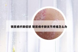 银屑病手脚症状 银屑病手脚关节疼痛怎么办