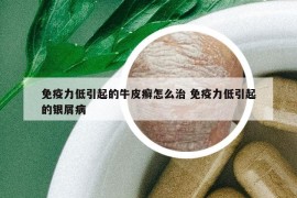 免疫力低引起的牛皮癣怎么治 免疫力低引起的银屑病