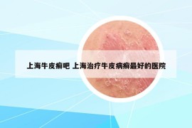 上海牛皮癣吧 上海治疗牛皮病癣最好的医院