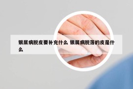 银屑病脱皮要补充什么 银屑病脱落的皮是什么