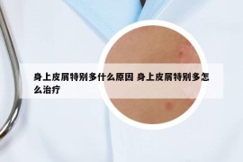 身上皮屑特别多什么原因 身上皮屑特别多怎么治疗