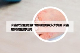 济南武警医院治好银屑病需要多少费用 济南银屑病医院收费