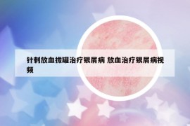 针刺放血拔罐治疗银屑病 放血治疗银屑病视频