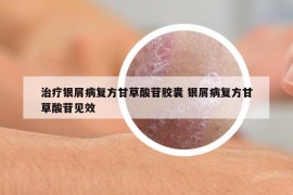 治疗银屑病复方甘草酸苷胶囊 银屑病复方甘草酸苷见效