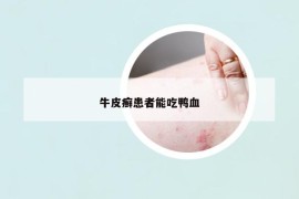 牛皮癣患者能吃鸭血