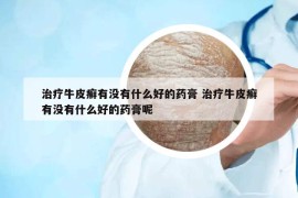 治疗牛皮癣有没有什么好的药膏 治疗牛皮癣有没有什么好的药膏呢