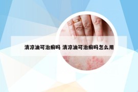 清凉油可治癣吗 清凉油可治癣吗怎么用