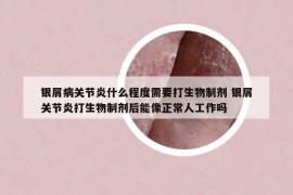 银屑病关节炎什么程度需要打生物制剂 银屑关节炎打生物制剂后能像正常人工作吗