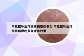 甲氨蝶呤治疗银屑病要吃多久 甲氨蝶呤治疗银屑病要吃多久才有效果