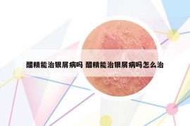 醋精能治银屑病吗 醋精能治银屑病吗怎么治