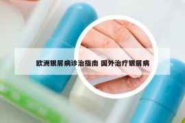 欧洲银屑病诊治指南 国外治疗银屑病