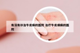 有没有诊治牛皮癣的医院 治疗牛皮病癣的医院