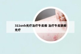 311uvb光疗治疗牛皮癣 治疗牛皮肤癣光疗