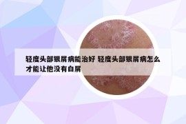 轻度头部银屑病能治好 轻度头部银屑病怎么才能让他没有白屑