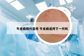 牛皮癣隔代遗传 牛皮癣遗传下一代吗