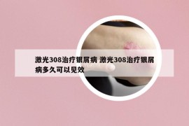 激光308治疗银屑病 激光308治疗银屑病多久可以见效