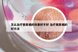 怎么治疗银屑病的效果好不好 治疗银屑病的好方法