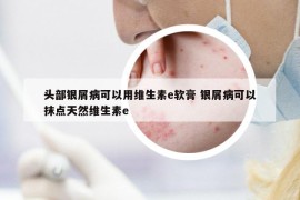 头部银屑病可以用维生素e软膏 银屑病可以抹点天然维生素e