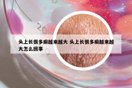 头上长很多癣越来越大 头上长很多癣越来越大怎么回事