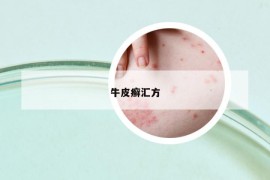 牛皮癣汇方