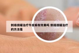 刺络拔罐治疗牛皮癣有效果吗 刺络拔罐治疗的方法是
