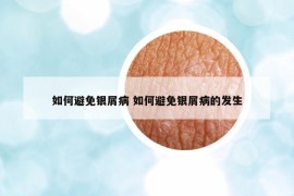 如何避免银屑病 如何避免银屑病的发生