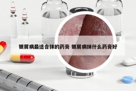 银屑病最适合抹的药膏 银屑病抹什么药膏好
