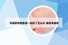 寻麻疹和银屑病一起的了怎么办 银屑荨麻疹