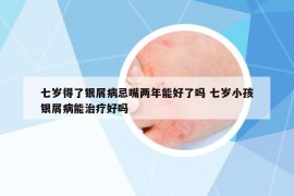 七岁得了银屑病忌嘴两年能好了吗 七岁小孩银屑病能治疗好吗