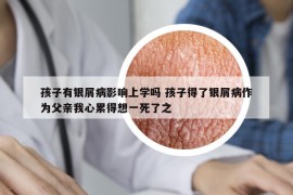 孩子有银屑病影响上学吗 孩子得了银屑病作为父亲我心累得想一死了之