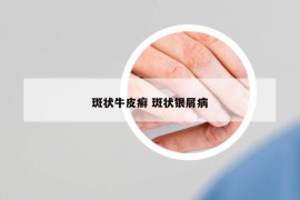 斑状牛皮癣 斑状银屑病