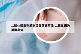 二硫化硒洗剂前胸后背正确用法 二硫化硒洗剂擦身体