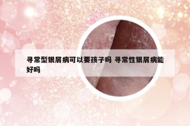 寻常型银屑病可以要孩子吗 寻常性银屑病能好吗