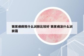 银屑病痒擦什么润肤比较好 银屑病涂什么润肤霜
